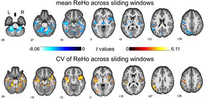 Aberrant Dynamics of Regional Coherence Measured by Resting-State fMRI in Children With Benign Epilepsy With Centrotemporal Spikes (BECTS)